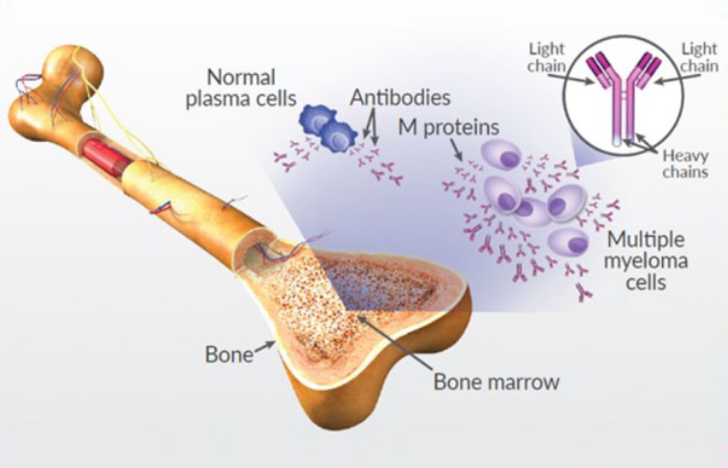 What is Multiple Myeloma?