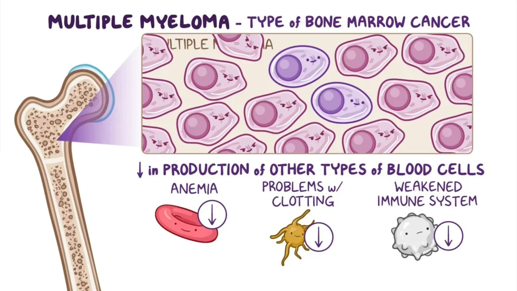 What is Multiple Myeloma?